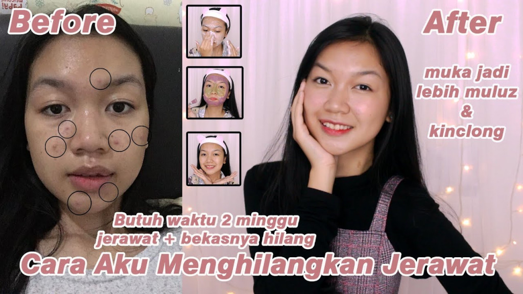 How To Get Rid of Acne & Acne Scars & Hyperpigmentation  Acne Story
